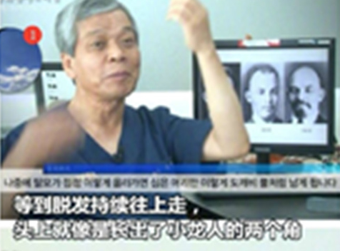 脱发走势 脱发走势
