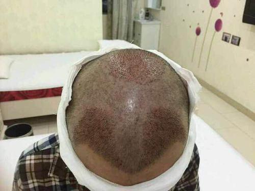 植发的原理和步骤