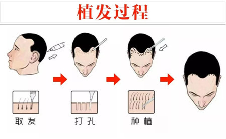 植发不是唯一的选择