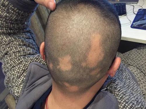 什么是斑秃？