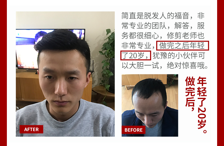 隐形无痕补发哪个好？多少钱？