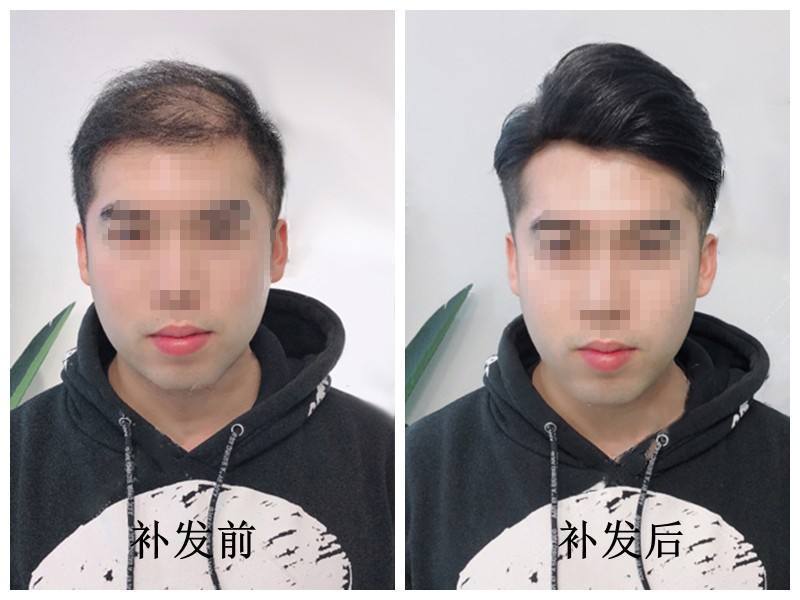 织发补发的效果怎么样？
