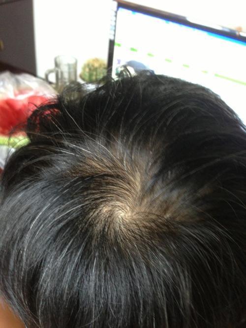 男人秃顶戴假发有用吗？有没有必要戴假发？​