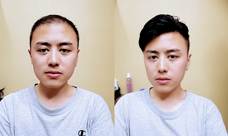 织发和补发前后效果对比图 织发和补发前后效果对比图