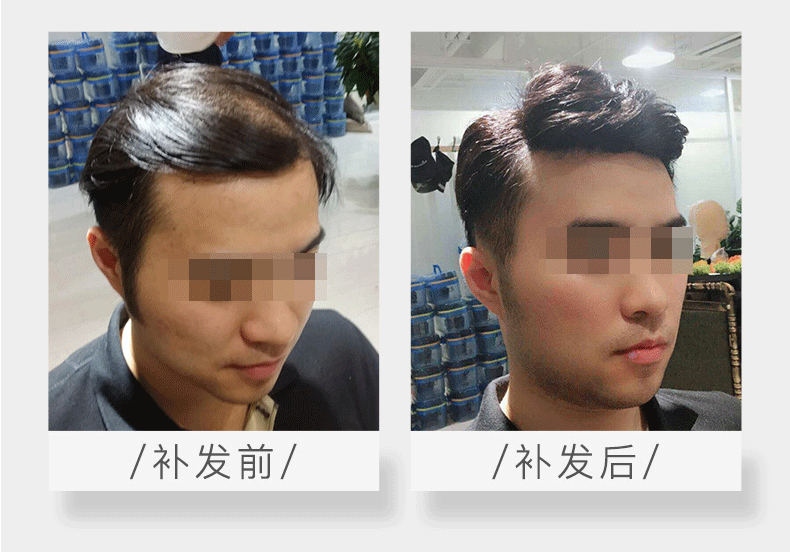 脱发严重有什么办法可以改变现状吗？