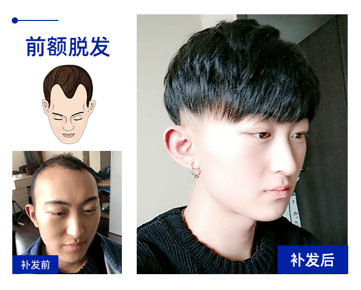 补发效果 补发效果
