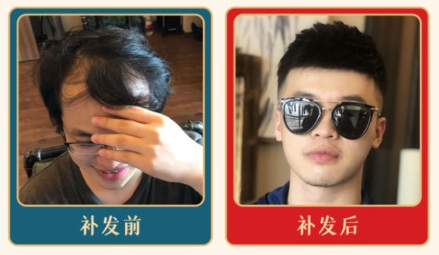 极客补发发际线怎么样？   