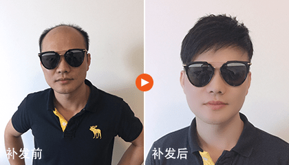 脱发问题现在还在困扰你吗？