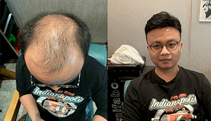 织发补发效果图 织发补发效果图
