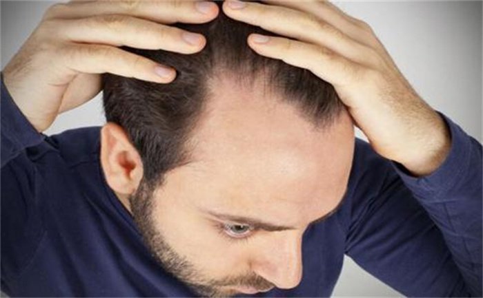 男人发际线后移怎么办？医生解答