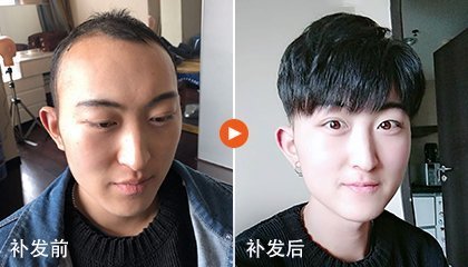 织发补发效果图 织发补发效果图