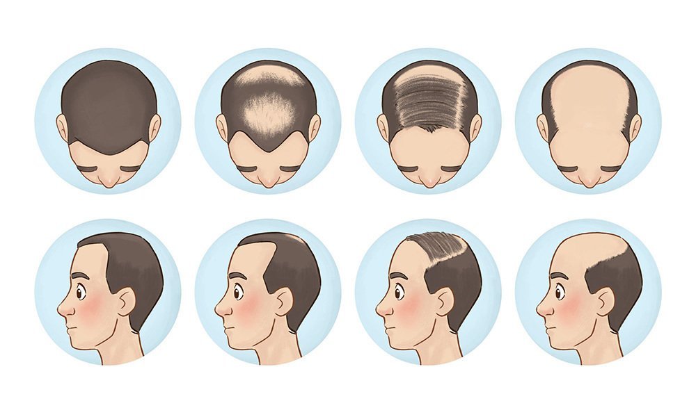 人为什么脱发？