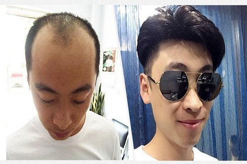 织发补发效果图 织发补发效果图
