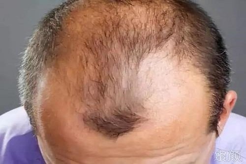 ​男性脱发的症状是什么？从这些方面入手缓解！