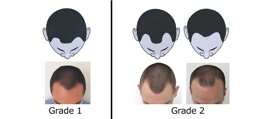 年轻人为何脱发？