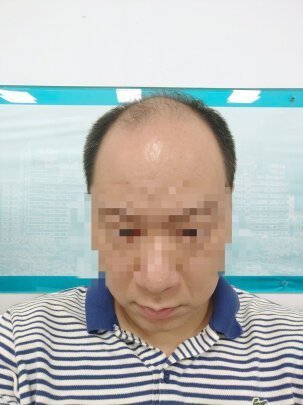 补发前效果