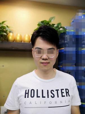 发际线补发后