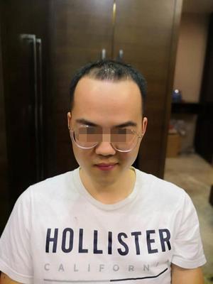 发际线补发前