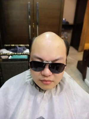 补发前秃头效果 补发前秃头效果