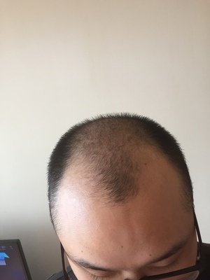 M型秃顶