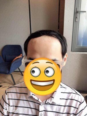 补发前高发际线 补发前高发际线