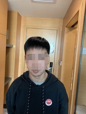 假发补发后效果图-正面 假发补发后效果图-正面