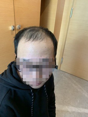 假发补发前效果图 假发补发前效果图