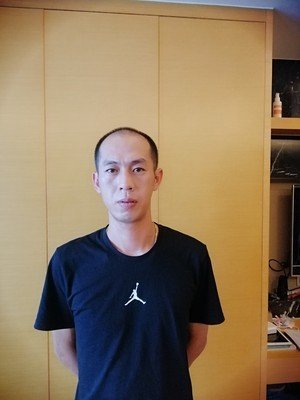 补发前秃顶效果图 补发前秃顶效果图