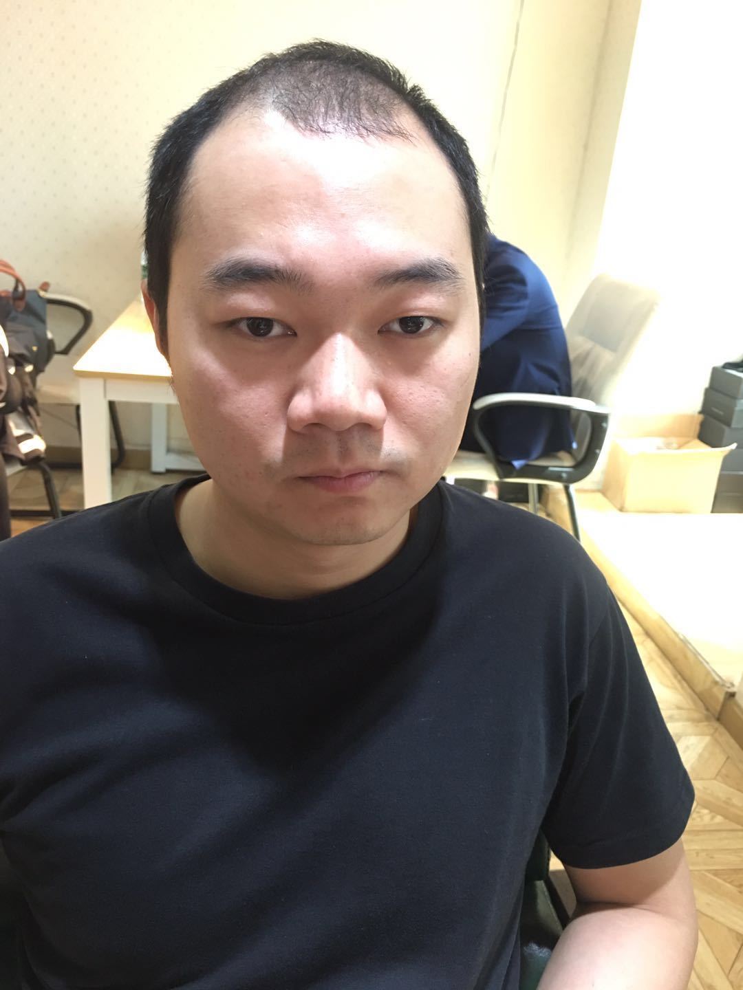 补发前M型脱发 补发前M型脱发