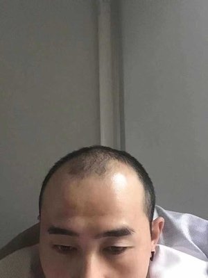 补发前的脱发状态 补发前的脱发状态
