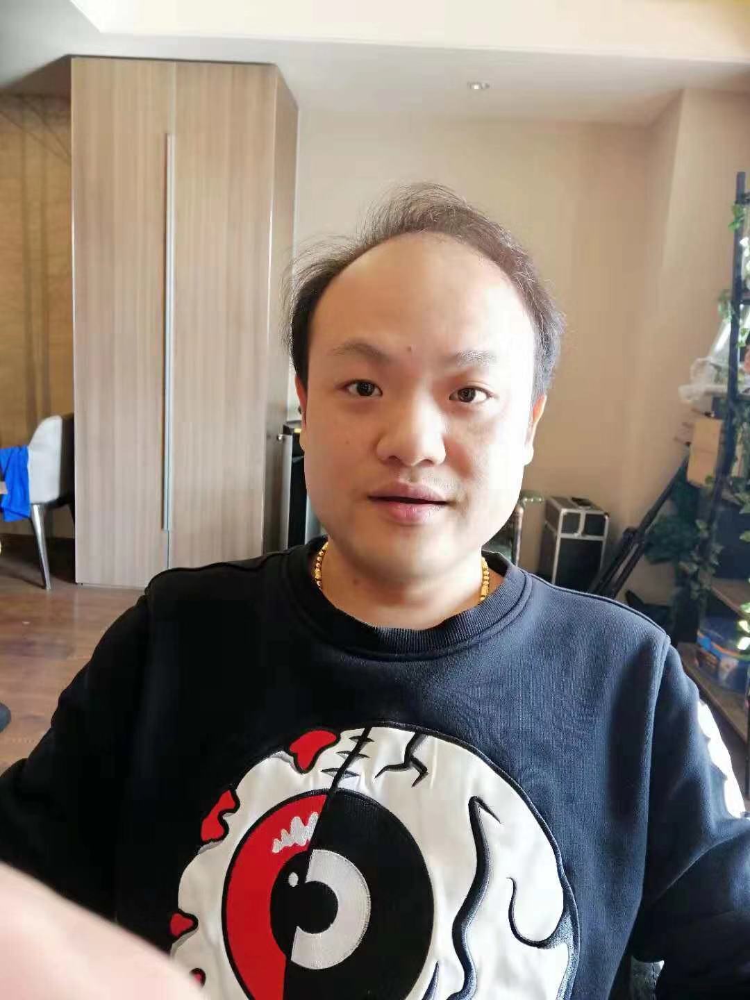 补发前脱发效果 补发前脱发效果