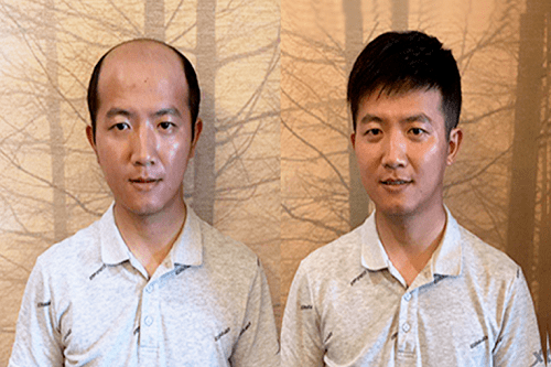​怎样降低脱发？脱发的掉头发的不一样！