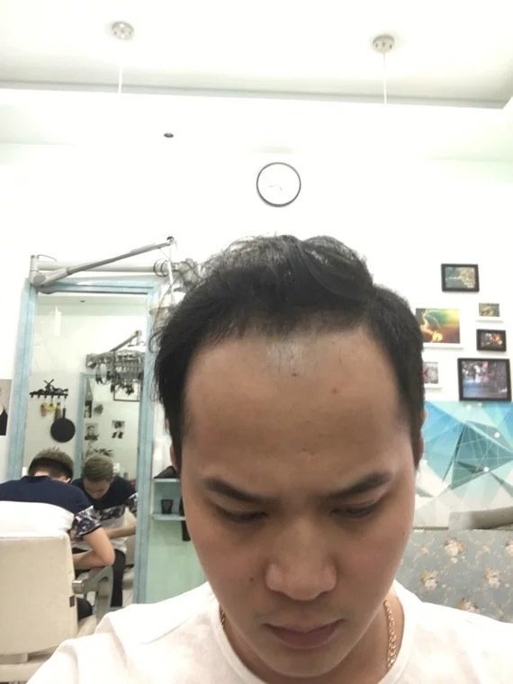 戴假发前效果 戴假发前效果