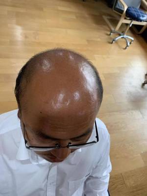 真人发丝补发前秃顶效果 真人发丝补发前秃顶效果