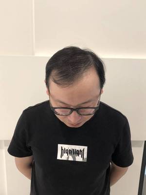 补发前高发际线效果 补发前高发际线效果