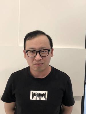 补发前高发际线效果 补发前高发际线效果