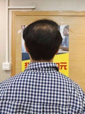 补发前头顶头发稀疏 补发前头顶头发稀疏