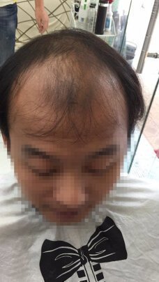 补发前头发稀疏 补发前头发稀疏