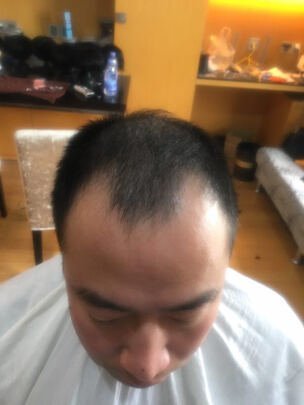 极客假发补发前M型脱发 极客假发补发前M型脱发