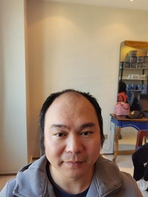 补发前发际线高、秃顶 补发前发际线高、秃顶