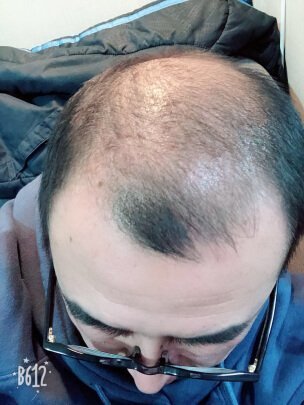 补发前秃顶效果 补发前秃顶效果