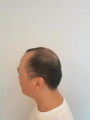 补发前侧面效果 补发前侧面效果