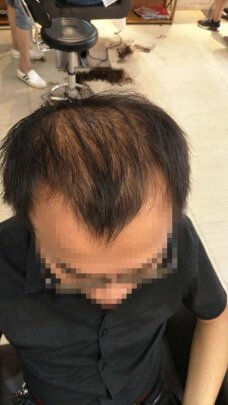 补发前头发稀疏 补发前头发稀疏