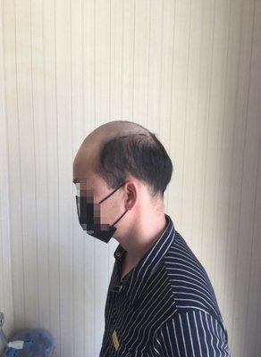 脱发秃顶严重，非常显老