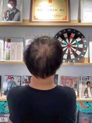 补发前头顶头发稀少
