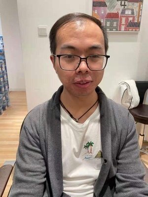 补发前，发际线后移严重