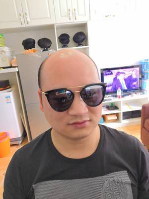 补发前发际线高 补发前发际线高