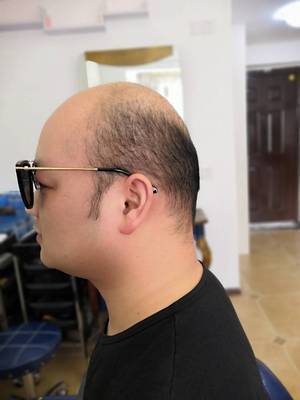 补发前秃顶 补发前秃顶
