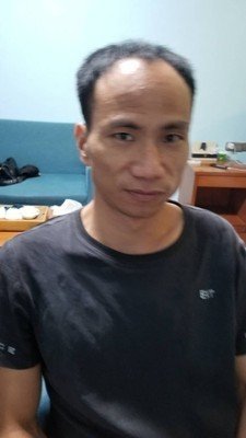 补发前发际线超高