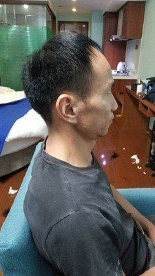 补发前侧面效果